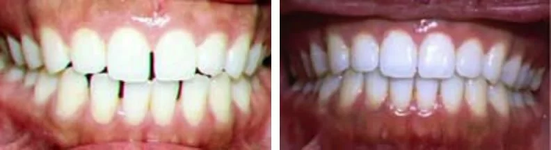 Invisalign braces before and after: Amy