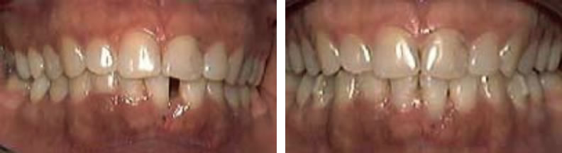 Invisilign braces before and after: Chris