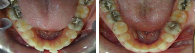 Invisalign braces before and after: Mike