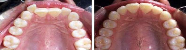 Invisilign braces before and after: Jennifer