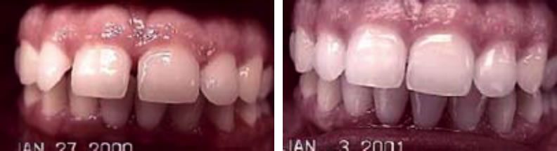 Invisalign braces before and after: Pat