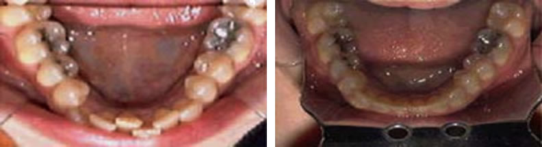 Invisilign braces before and after: Michelle