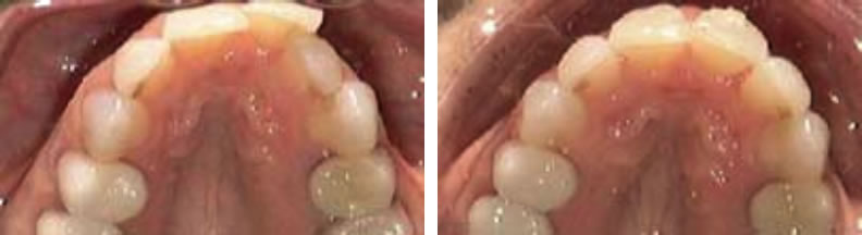 Invisalign braces before and after: David